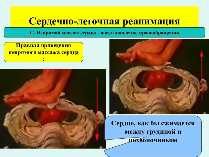 Сердечно-легочная реанимация С. Непрямой массаж сердца - восстановление кровообращения Правила проведения