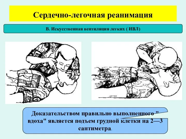 Сердечно-легочная реанимация В. Искусственная вентиляция легких ( ИВЛ) Доказательством правильно выполненного