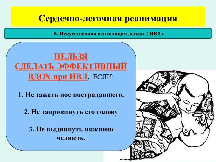 Сердечно-легочная реанимация В. Искусственная вентиляция легких ( ИВЛ) НЕЛЬЗЯ СДЕЛАТЬ ЭФФЕКТИВНЫЙ