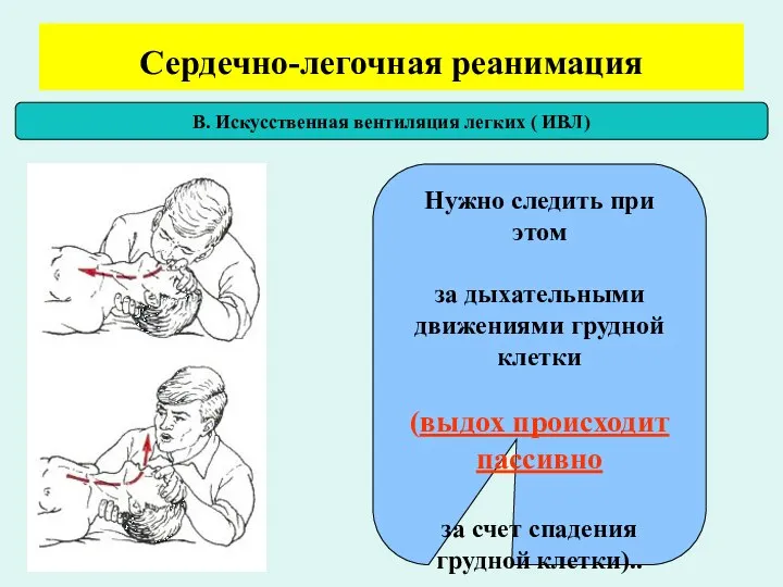 Сердечно-легочная реанимация В. Искусственная вентиляция легких ( ИВЛ) Нужно следить при