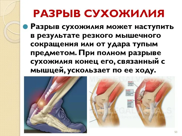 РАЗРЫВ СУХОЖИЛИЯ Разрыв сухожилия может наступить в результате резкого мышечного сокращения