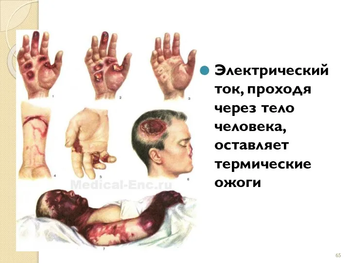 Электрический ток, проходя через тело человека, оставляет термические ожоги