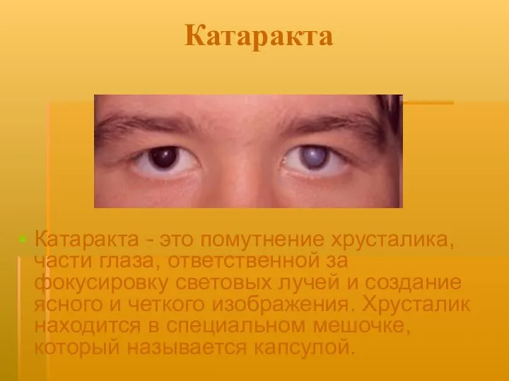 Катаракта Катаракта - это помутнение хрусталика, части глаза, ответственной за фокусировку