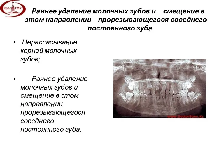 Раннее удаление молочных зубов и смещение в этом направлении прорезывающегося соседнего