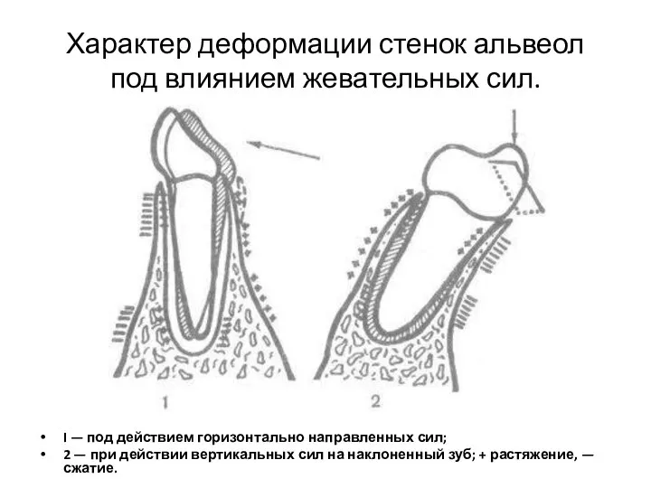 Характер деформации стенок альвеол под влиянием жевательных сил. I — под