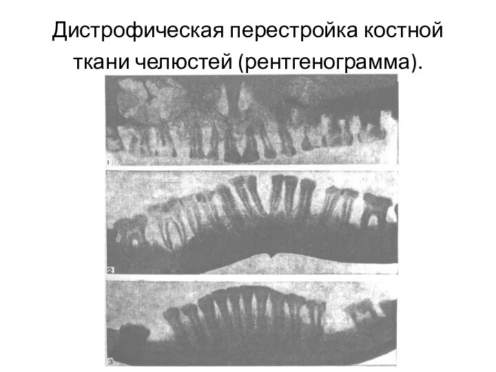 Дистрофическая перестройка костной ткани челюстей (рентгенограмма). .