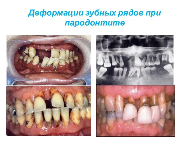 Деформации зубных рядов при пародонтите