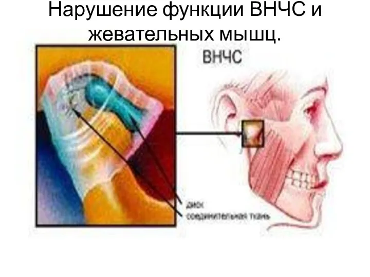 Нарушение функции ВНЧС и жевательных мышц.