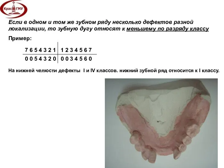 Если в одном и том же зубном ряду несколько дефектов разной