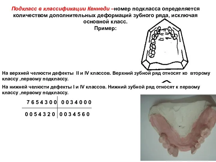 Подкласс в классификации Кеннеди –номер подкласса определяется количеством дополнительных деформаций зубного