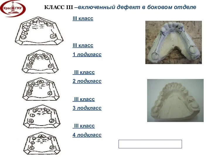 КЛАСС III –включенный дефект в боковом отделе III класс III класс