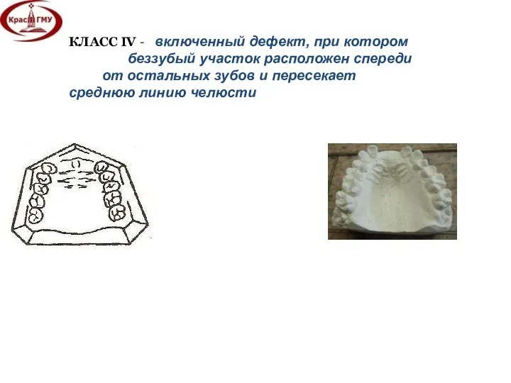 КЛАСС IV - включенный дефект, при котором беззубый участок расположен спереди