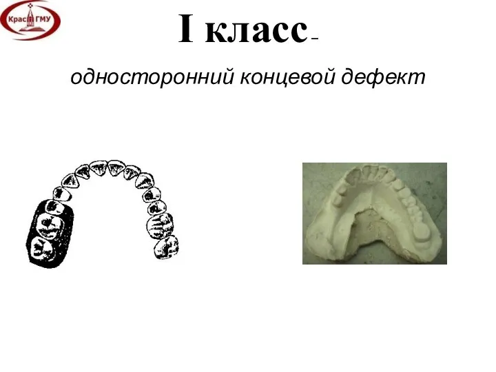 I класс – односторонний концевой дефект