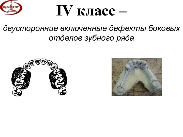 IV класс – двусторонние включенные дефекты боковых отделов зубного ряда