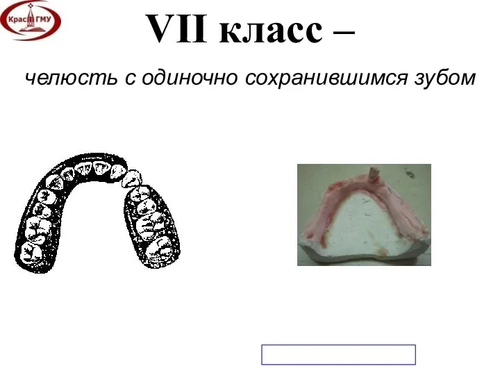 VII класс – челюсть с одиночно сохранившимся зубом