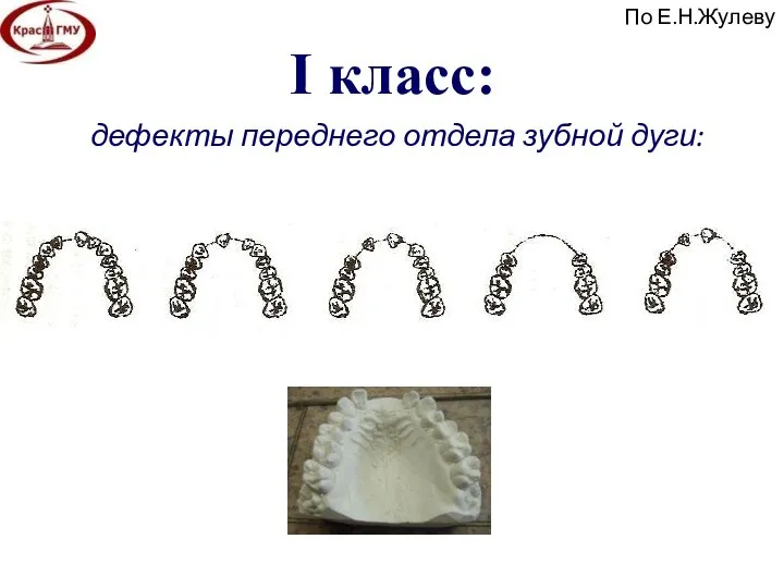 I класс: дефекты переднего отдела зубной дуги: По Е.Н.Жулеву