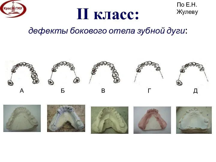 II класс: дефекты бокового отела зубной дуги: По Е.Н.Жулеву А Б В Г Д