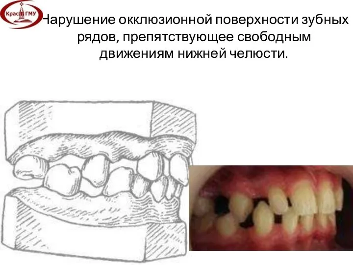 Нарушение окклюзионной поверхности зубных рядов, препятствующее свободным движениям нижней челюсти.