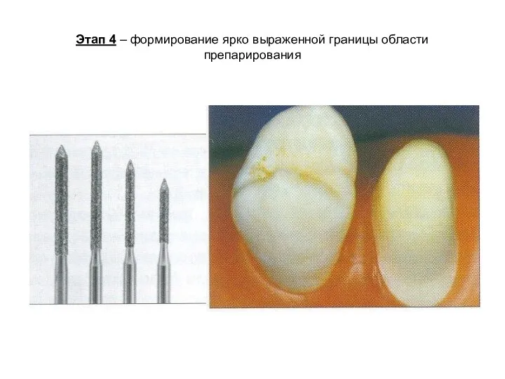 Этап 4 – формирование ярко выраженной границы области препарирования