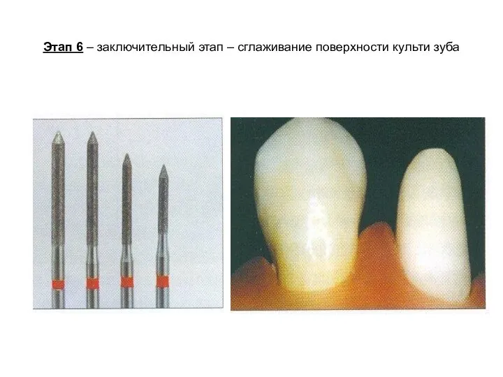 Этап 6 – заключительный этап – сглаживание поверхности культи зуба