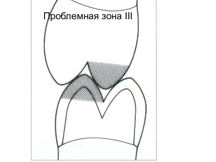 Проблемная зона III