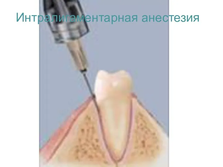 Интралигаментарная анестезия