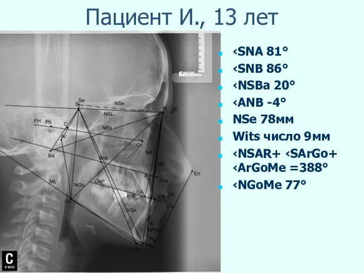 Пациент И., 13 лет ‹SNA 81° ‹SNB 86° ‹NSBa 20° ‹ANB