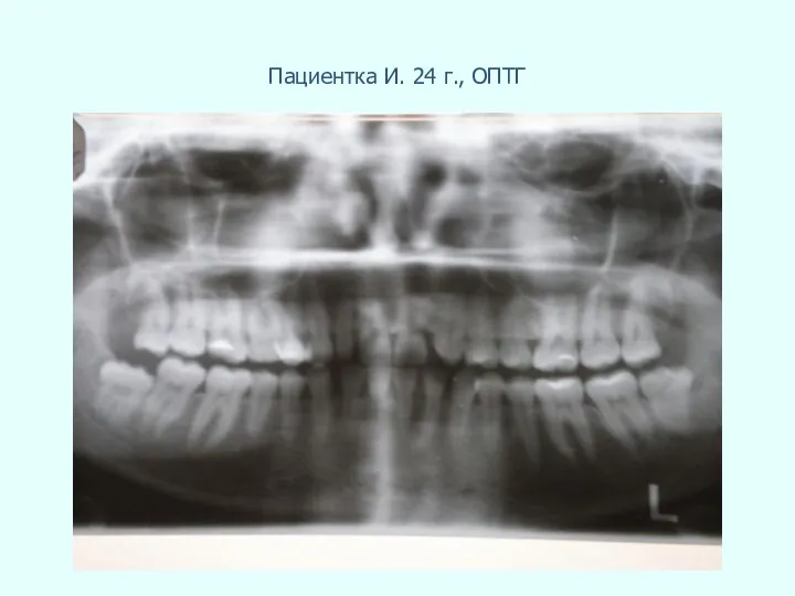 Пациентка И. 24 г., ОПТГ