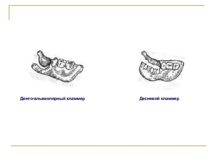 Денто-альвеолярный кламмер Десневой кламмер