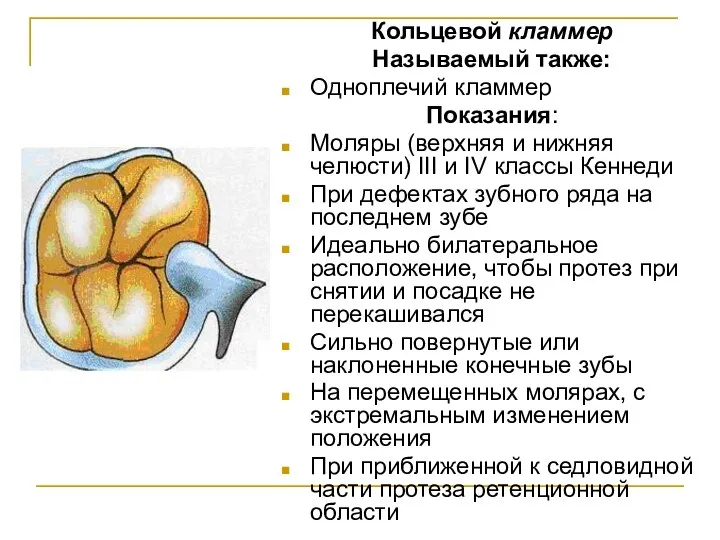 Кольцевой кламмер Называемый также: Одноплечий кламмер Показания: Моляры (верхняя и ниж­няя