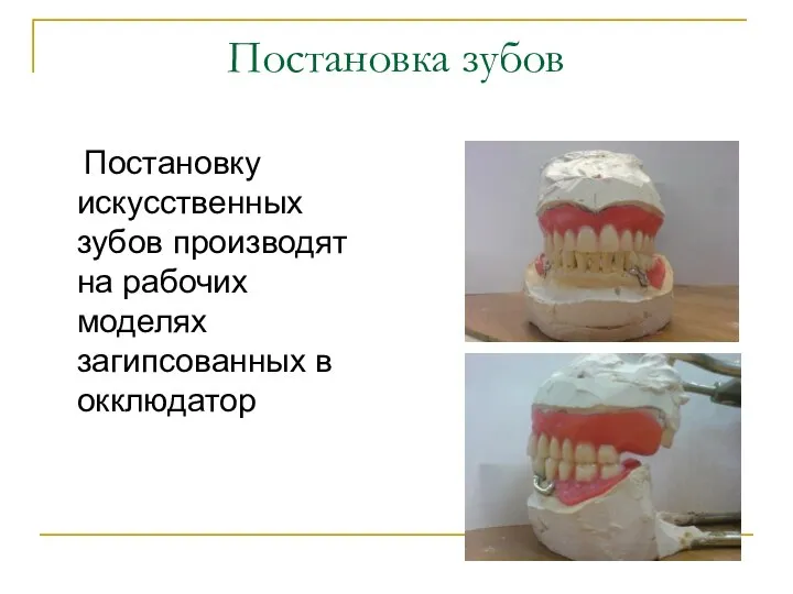 Постановку искусственных зубов производят на рабочих моделях загипсованных в окклюдатор Постановка зубов