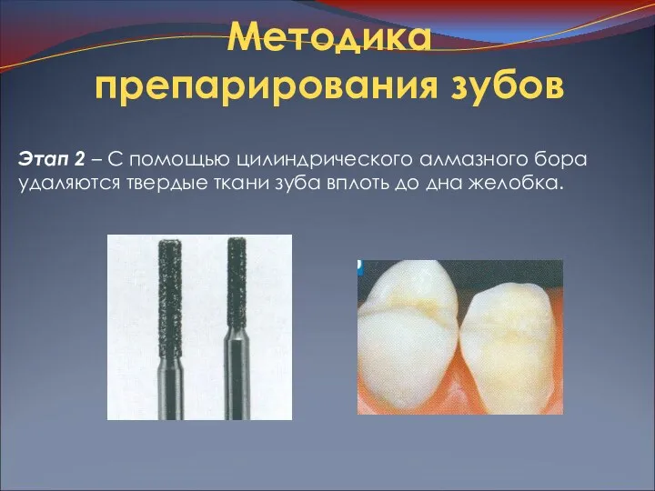 Методика препарирования зубов Этап 2 – С помощью цилиндрического алмазного бора