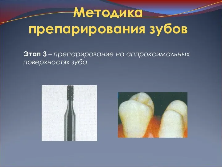 Методика препарирования зубов Этап 3 – препарирование на аппроксимальных поверхностях зуба