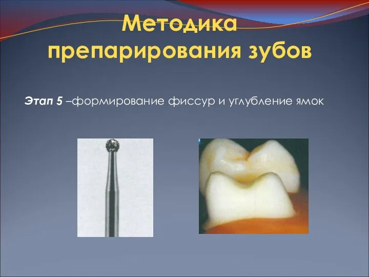 Методика препарирования зубов Этап 5 –формирование фиссур и углубление ямок