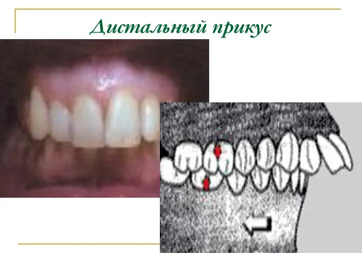 Дистальный прикус