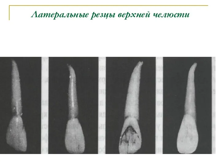 Латеральные резцы верхней челюсти