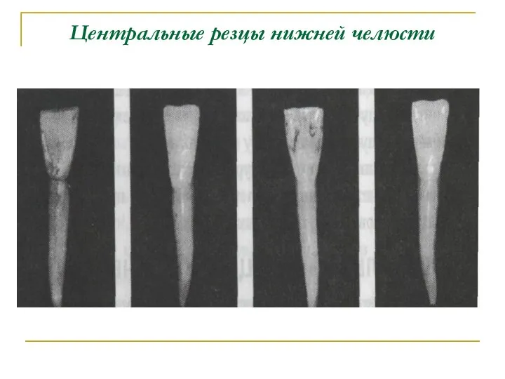 Центральные резцы нижней челюсти