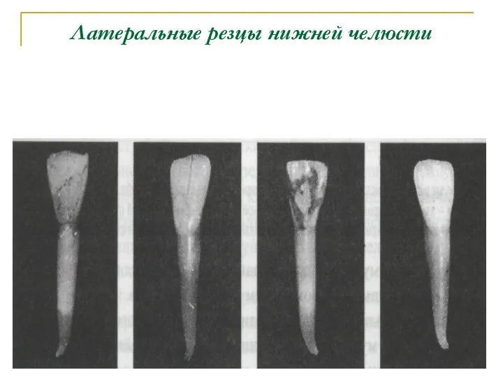 Латеральные резцы нижней челюсти