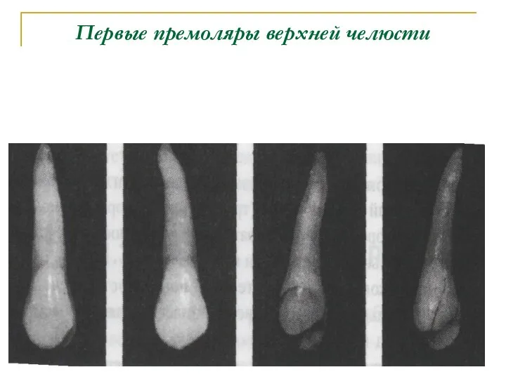 Первые премоляры верхней челюсти