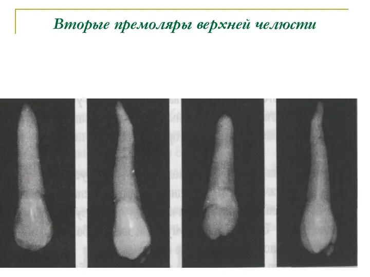 Вторые премоляры верхней челюсти