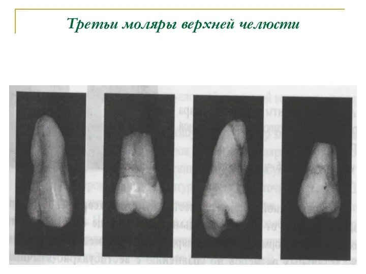 Третьи моляры верхней челюсти