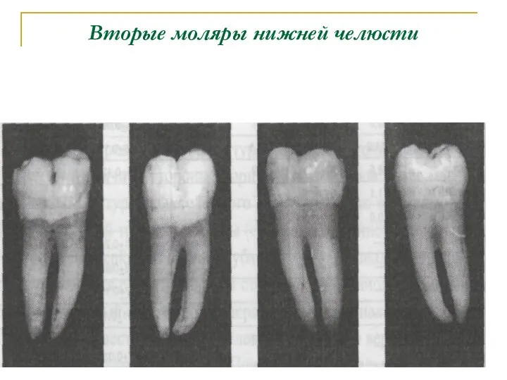 Вторые моляры нижней челюсти