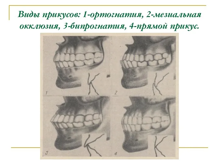 Виды прикусов: 1-ортогнатия, 2-мезиальная окклюзия, 3-бипрогнатия, 4-прямой прикус.