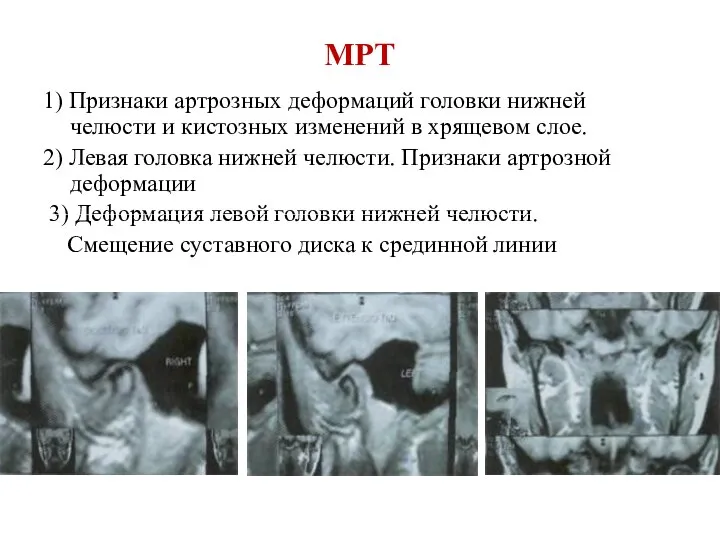 МРТ 1) Признаки артрозных деформаций головки нижней челюсти и кистозных изменений