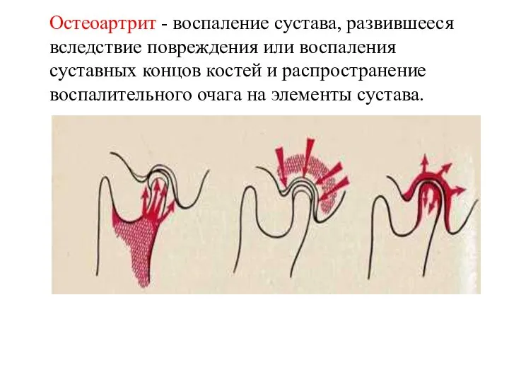 Остеоартрит - воспаление сустава, развившееся вследствие повреждения или воспаления суставных концов