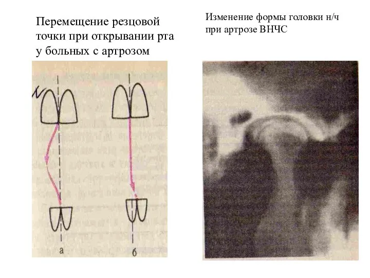 Перемещение резцовой точки при открывании рта у больных с артрозом ВНЧС