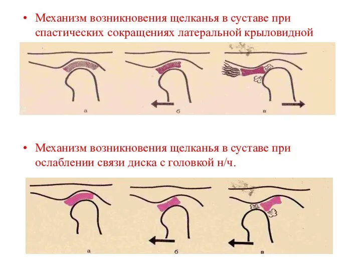 Механизм возникновения щелканья в суставе при спастических сокращениях латеральной крыловидной мышцы.