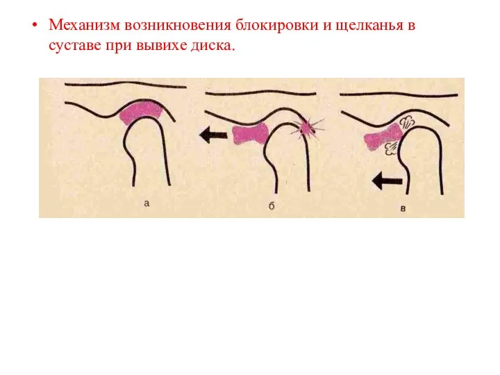 Механизм возникновения блокировки и щелканья в суставе при вывихе диска.