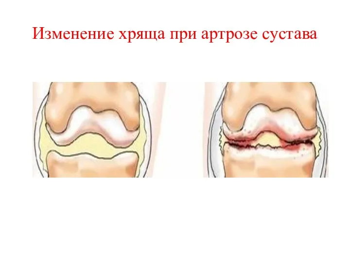 Изменение хряща при артрозе сустава