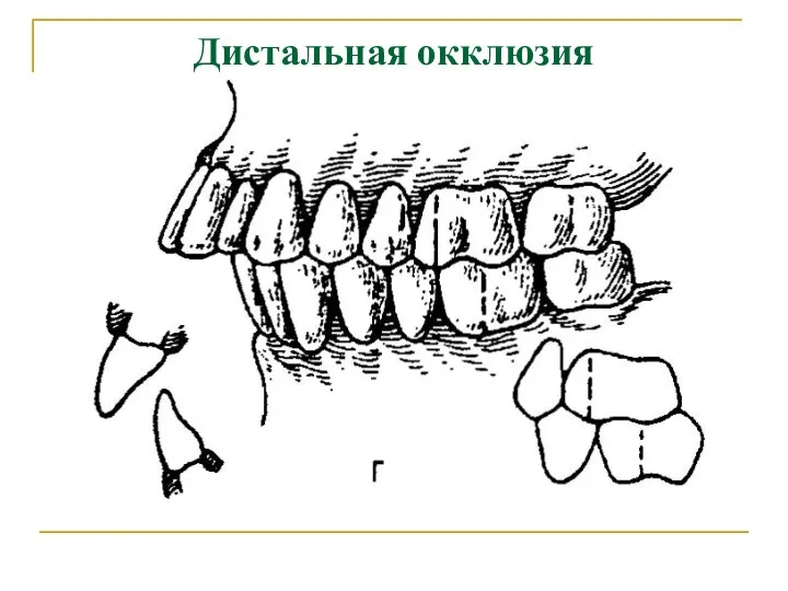 Дистальная окклюзия